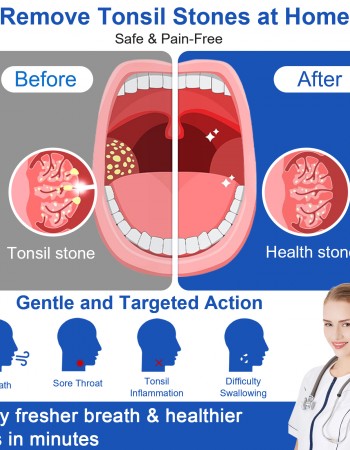 Tonsil Stone Vacuum Remover with LED Light Upgraded Electronic Oral Care Cleaning Tool Set 6 Suction Levels for Fresh Breath & Comfortable Use (White)